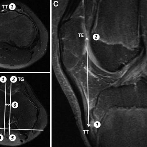 Change Of Tibial Tuberosity Trochlear Groove Tt Tg Index With Aging