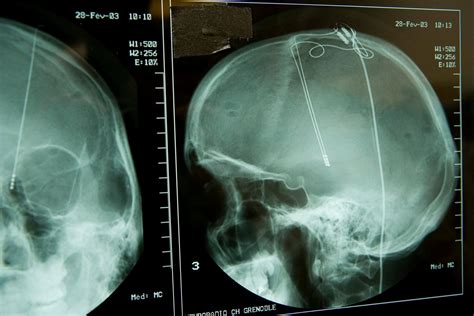 Tiefe Hirnstimulation Verbessert Kognitive Funktion Nach Sch Del Hirn