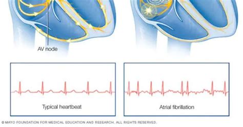 Extreme Training And Afib Krwg Public Media