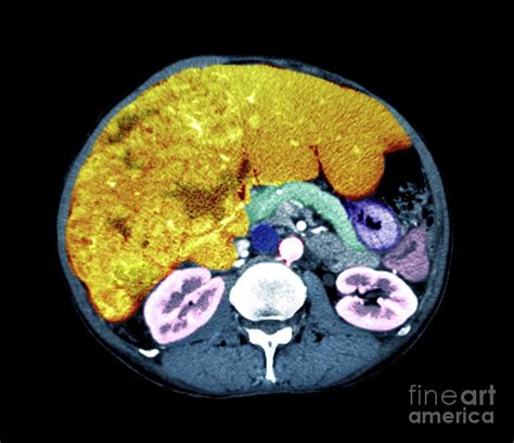 Liver Cancer Photograph By Zephyr Science Photo Library Pixels