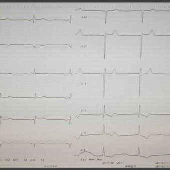 A The Twelve Lead Electrocardiogram Showed Left Ventricular