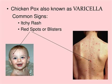 Ppt Chicken Pox Powerpoint Presentation Free Download Id 6694026