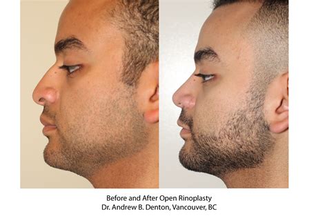 Before And After Open Rhinoplasty Dr Andrew B Denton Vancouver BC