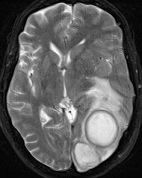 Imaging Of Intracranial Infectious Diseases In Adults Applied Radiology