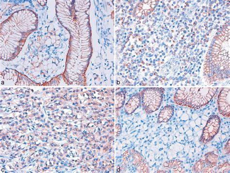 3 E Cadherin Immunostaining Patterns That Can Be Observed In Precursor