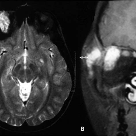 Axial T2 Weighted Mri Scan Stir A Showing Two Different Markedly