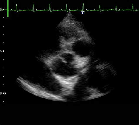 Tte Parasternal Short Axis View Of The Pv Showing A Large Vegetation Download Scientific