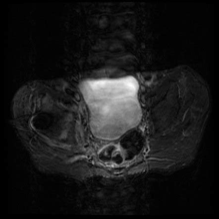 Pelvic Osteosarcoma Image Radiopaedia Org