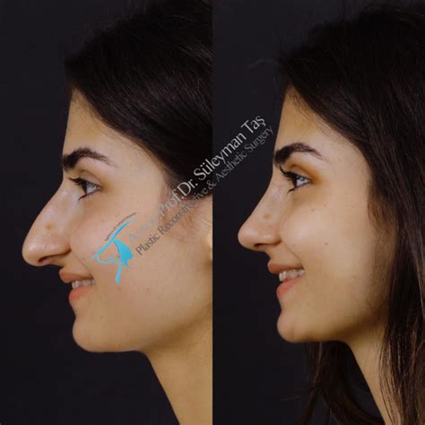 Rhinoplasty Gallery Assoc Prof Dr Suleyman Tas Best Plastic