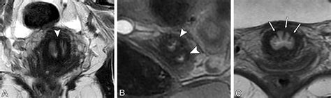 Müllerian Duct Anomalies Role In Fertility And Pregnancy Radiographics