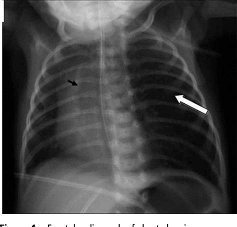 Figure From Mediastinal Bronchogenic Cyst Mimicking Congenital Lobar