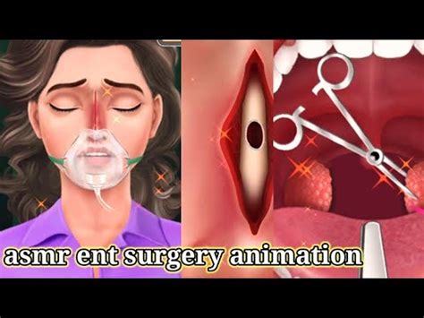 Asmr Surgery Animation Video Ent Surgery Animation Asmr Divine