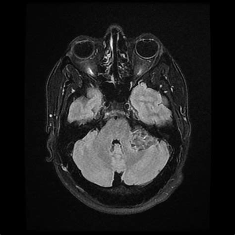 Intracranial Epidermoid Cyst Image Radiopaedia Org