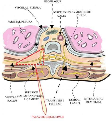 The Paravertebral Space Thoracal Paravertebral Block For Breast