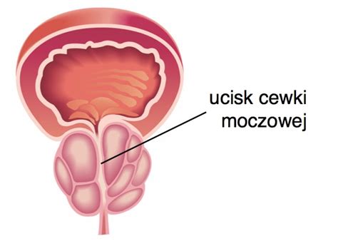 Choroby Prostaty Zapalenie Prostaty Przerost I Rak Prostaty