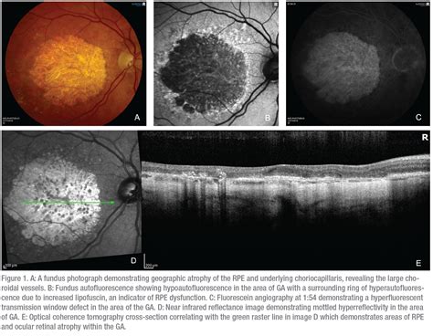 Whats Ahead For The Treatment Of Dry Amd