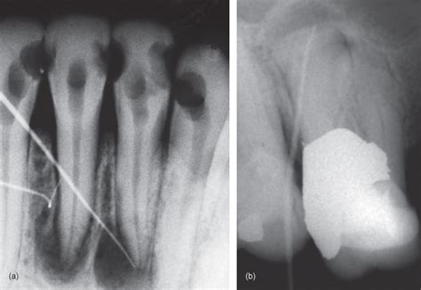 Canal Lateral X Ray