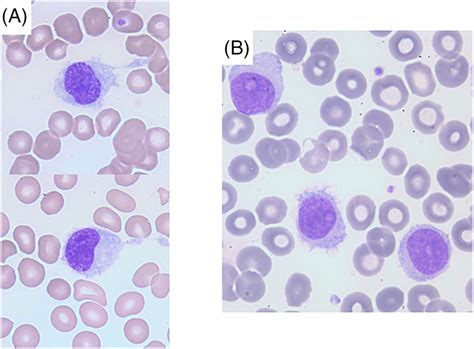 Hairy Cell Variant Leukemia