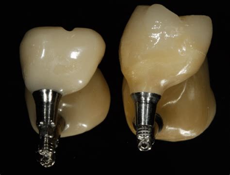 Screw-retained Implant | TWINS DENTAL LAB