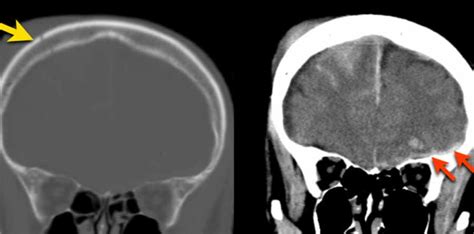 The Radiology Assistant Traumatic Intracranial Hemorrhage