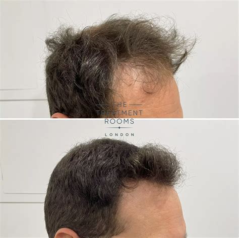 Balding Crown And Crown Hair Transplant Treatment Rooms London