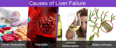 Liver Failure Types Causes Symptoms Complications Diagnosis