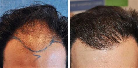 Grafts Hair Transplant Coverage Results Costs