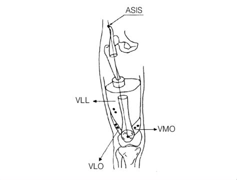 Positioning Of The Electrodes On The Vastus Medialis Obliquus Vmo