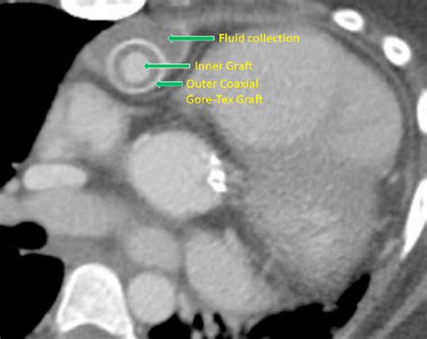 Post Operative Seroma Formation Axial Ct Image Shows Fluid Density Download Scientific Diagram