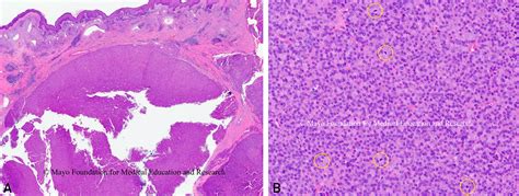 Oncocytic Poorly Differentiated Thyroid Carcinoma Mayo Clinic Proceedings