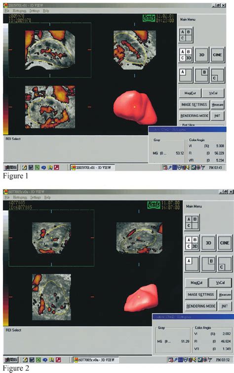 Three Dimensional 3d Power Doppler Ultrasonography Histogram Analysis Download Scientific