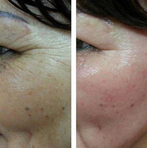 Thermage Before And After Photos Face (6) » Facelift: Info, Prices, Photos, Reviews, Q&A