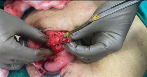 Figure From A Curious Case Of Enterocutaneous Fistula In Incisional