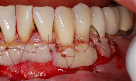 Enxerto Gengival Cirurgia Sutura Lu S Gustavo Leite Dentista