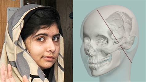 How doctors will repair Malala Yousafzai’s skull – Channel 4 News