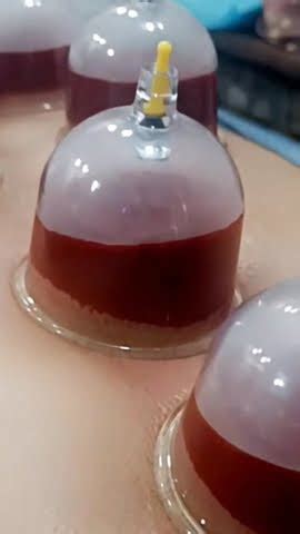 Hijama Or Cupping Therapy Sunnah In Islaam Best For Health