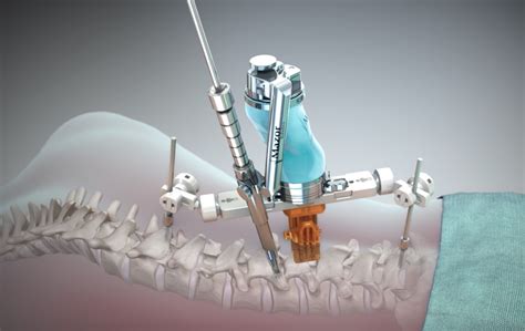 Tampa Robotic Lung Neck And Back Surgery Surgeon Treatment Total Spine And Brain Institute