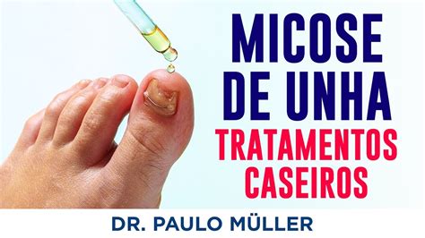 3 Tratamentos Caseiros Para Micose De Unha Dr Paulo Müller