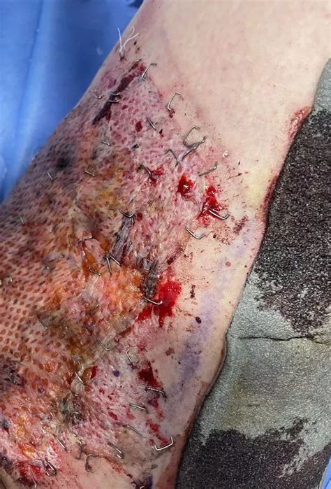 I Used A Hot Water Bottle For My Period Pains But Woke Up On Kitchen Floor With Scars For