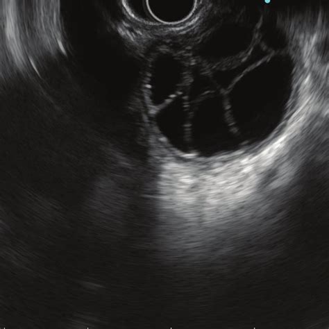 Eus Imaging Showing Hydatid Cyst Of Liver With Classical Cartwheel Download Scientific Diagram