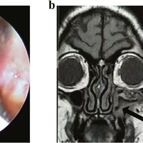 Illustration Of Mucormycosis Infection Spreading To The Nasal