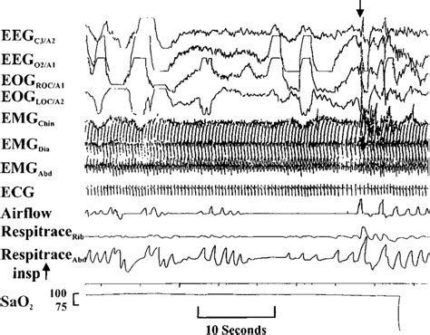 Infant Apnea