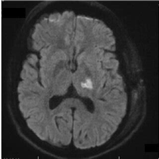 Axial Diffusion Weighted Mri Shows Restricted Diffusion In The