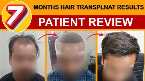 7 Months Hair Transplant Results Patient Review From Balding To Bold Cost Of Hair