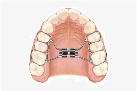 Descubre El Disyuntor De Paladar En Ortodoncia Pandp Clinic