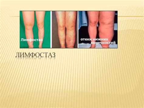 Лимфаайналының бұзылуы турлері. Лимфостаз. Лимфа тамырлардағы тробмоз ...