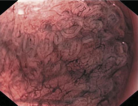 Endoscopic Assessment And Grading Of Barretts Esophagus Using