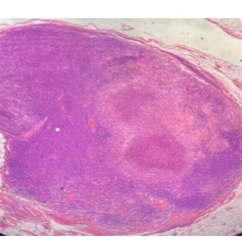 FIGURE E Section Examined Reveals Lymph Node Showing Areas Of Necrosis