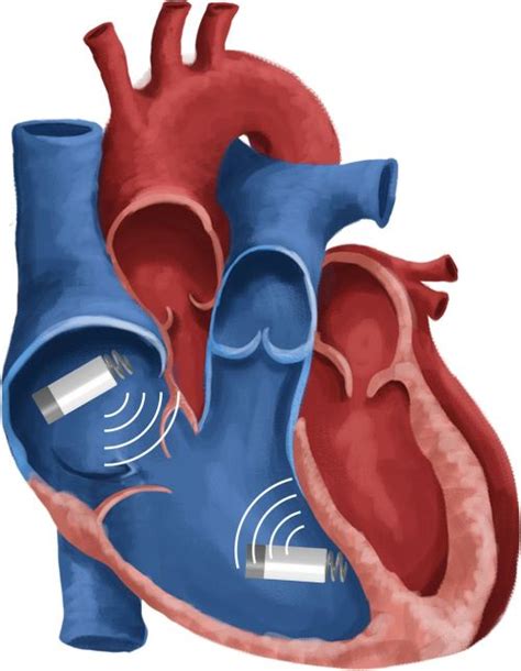 Newer Frontiers In Cardiac Pacing Wireless Dual Chamber Pacing Drs