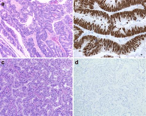 Well Differentiated Sinonasal Intestinal Type Adenocarcinoma A With